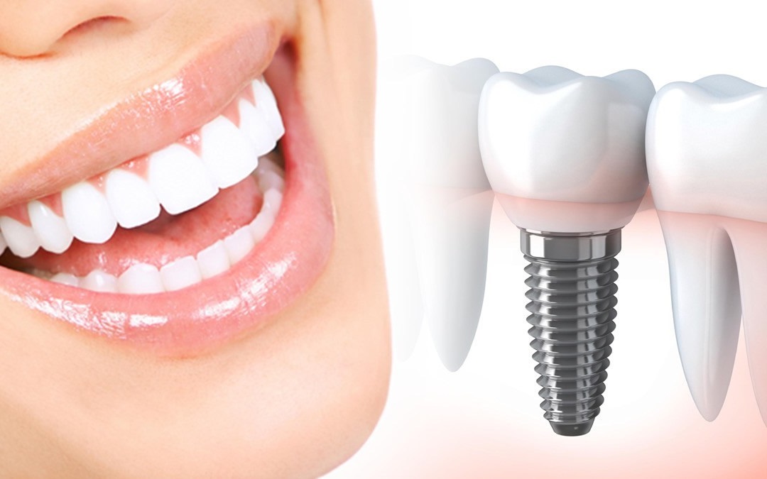 Что такое зубной имплант?